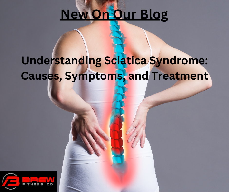 Understanding Sciatica Syndrome: Causes, Symptoms, and Treatment